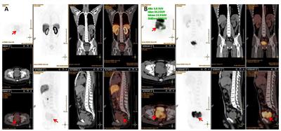 18F-Prostate-Specific Membrane Antigen and 18F-Fluorodeoxyglucose PET/CT Unmasked the Characteristics of Prostate Lymphoma: A Case Report and Literature Review